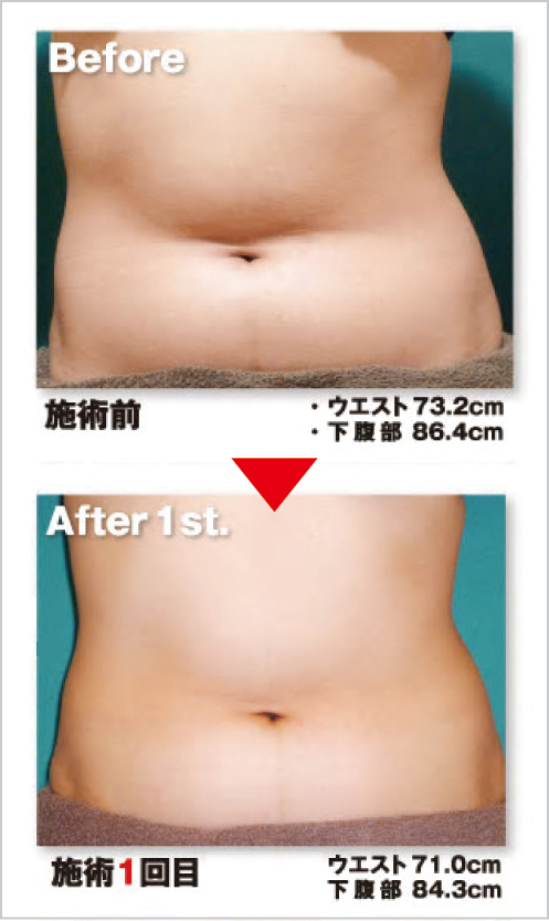 Before After Before After